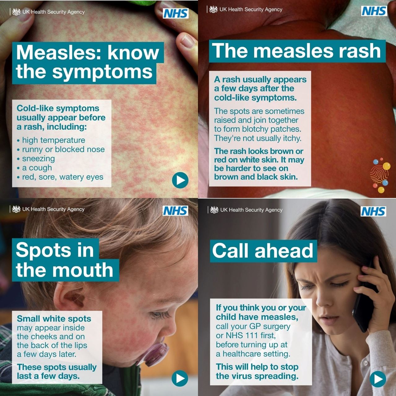 Measles